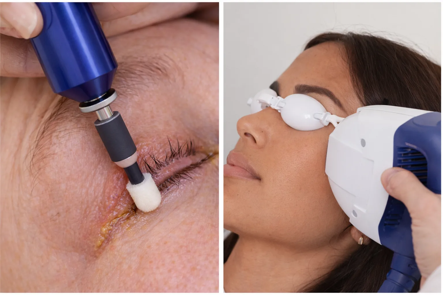 Split view of lid-margin debridement tool and IPL handpiece near the eye.
