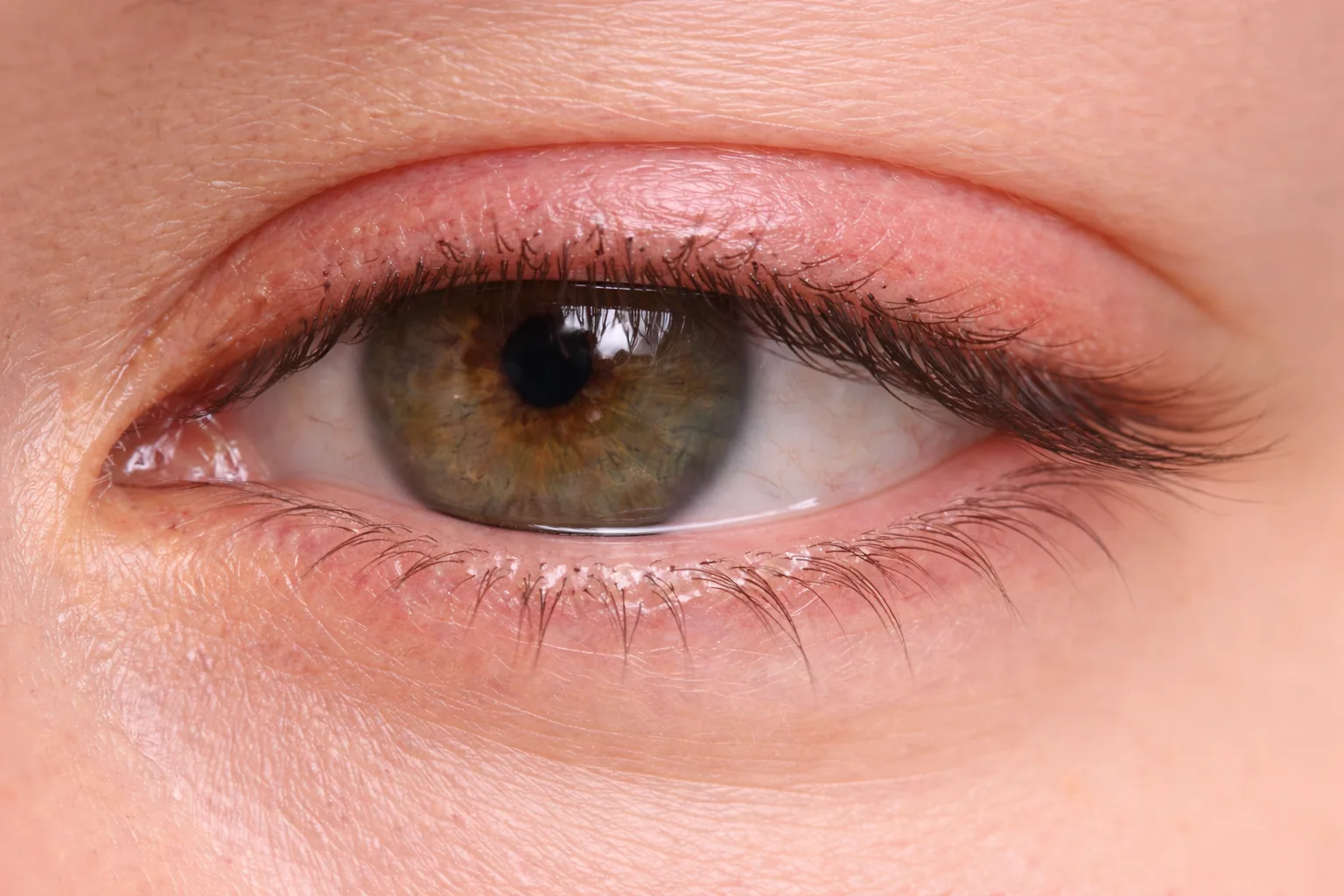 Mildly irritated eye with subtle lid margin redness and watery tear meniscus.